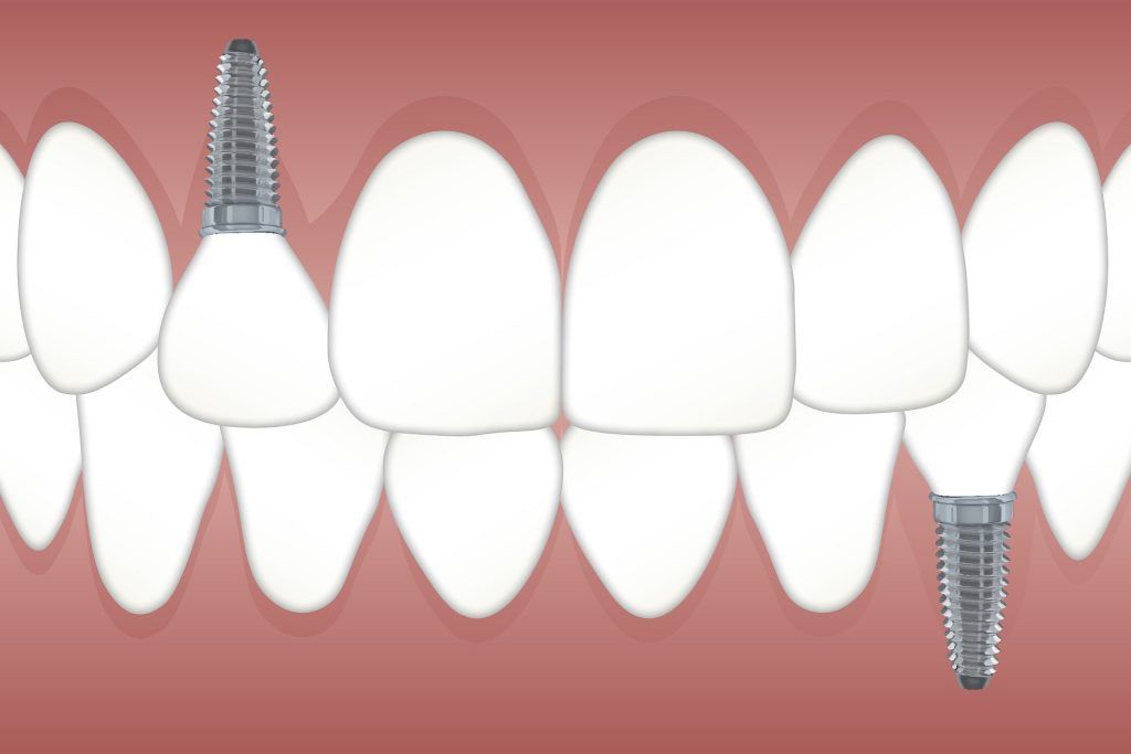 Si se quiere una buena salud bucodental es importante reponer los dientes perdidos a la mayor brevedad posible