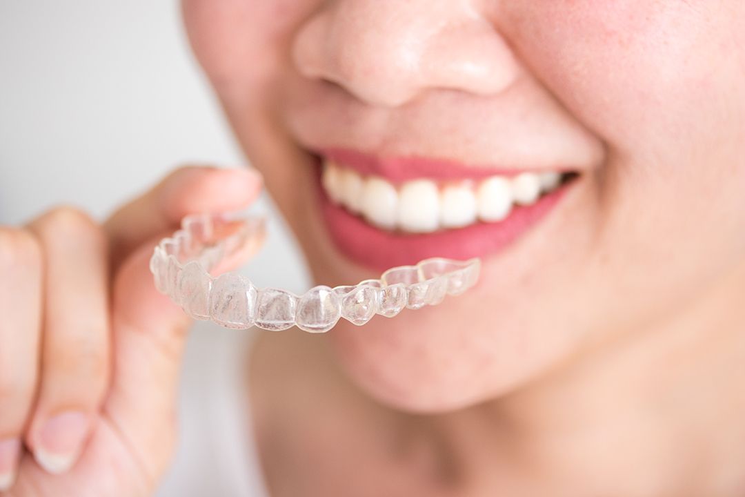 Una de las ventajas de usar Invisalign es que es removible, por lo que se puede quitar para comer, beber y lavarse los dientes