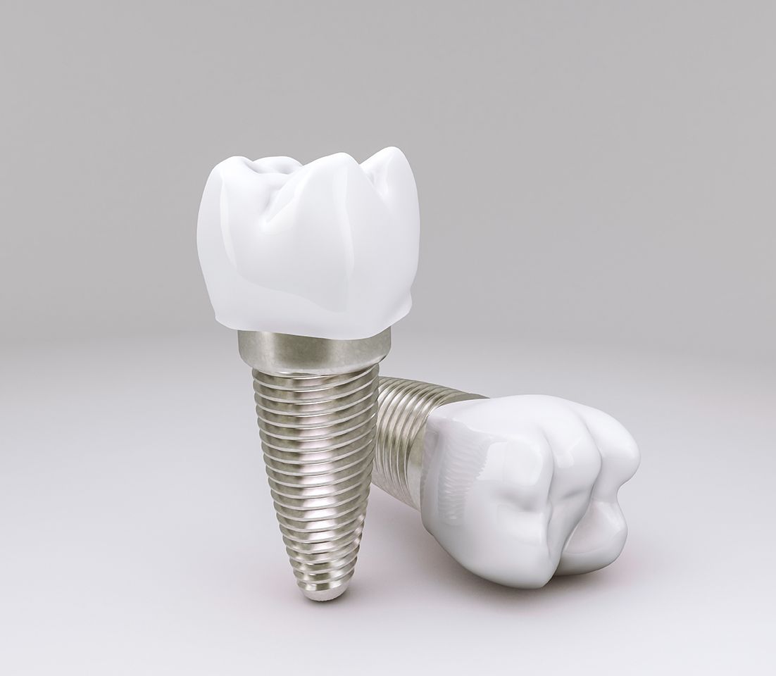 protocolo implantológico para colocar los implantes dentales en Vigo
