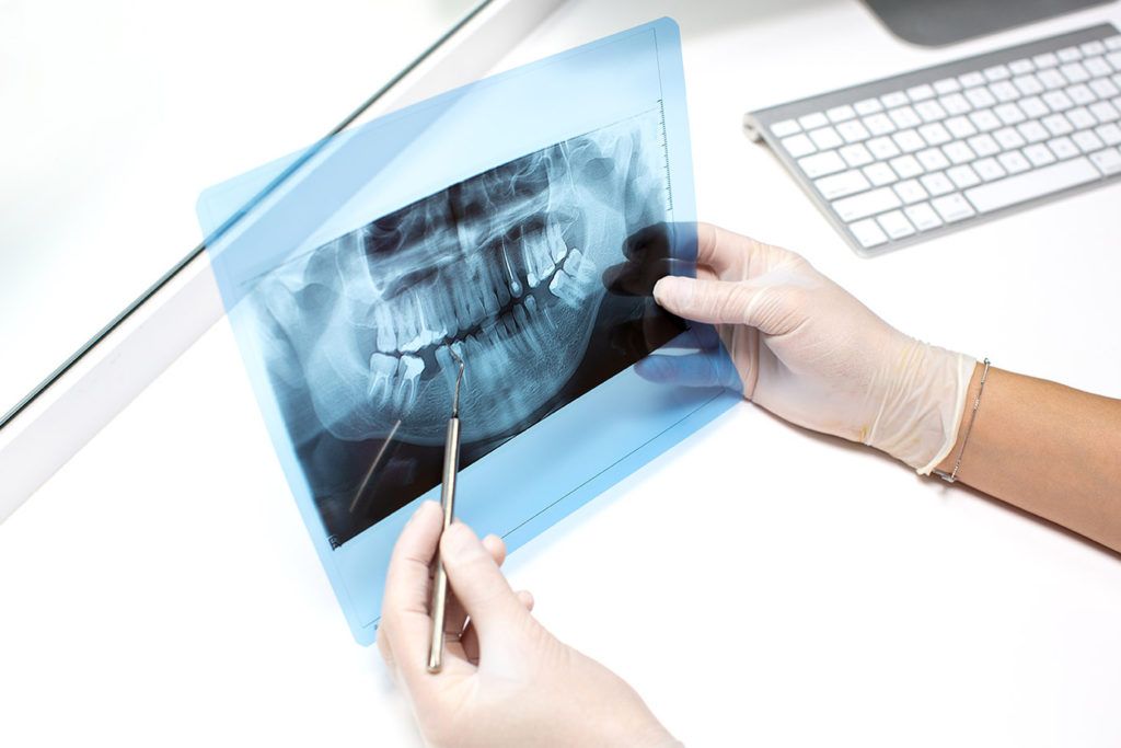 En la endodoncia se extrae el tejido pulpar y se sustituye por material inerte
