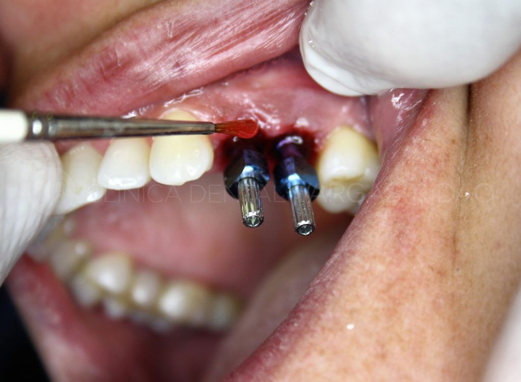 La pérdida de dientes puede deberse a diferentes causas como la periodontitis o las caries muy severas