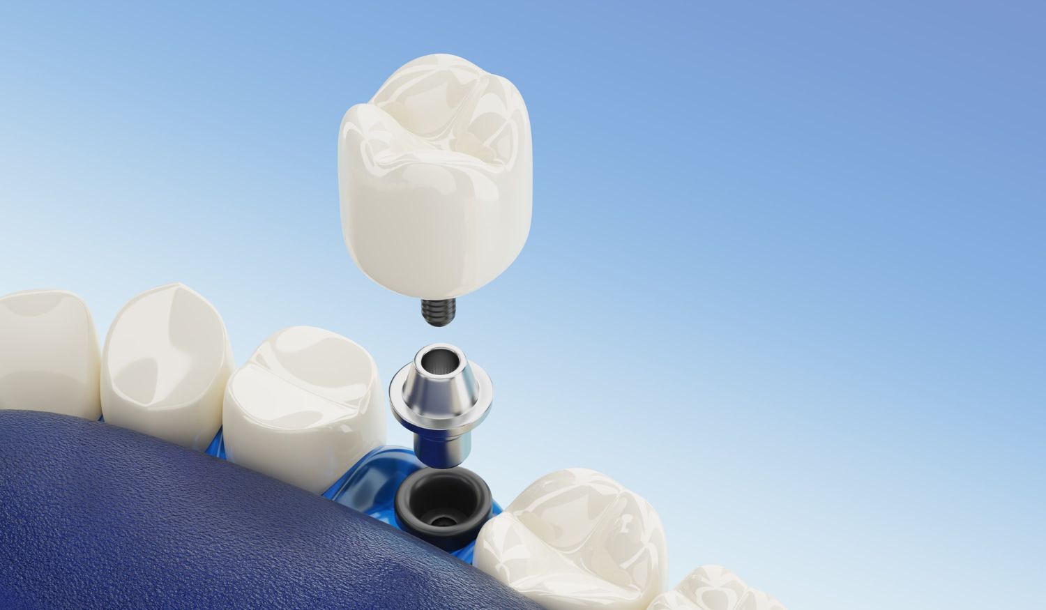 Colocarse implantes dentales en Vigo es una excelente solución para reponer los dientes perdidos