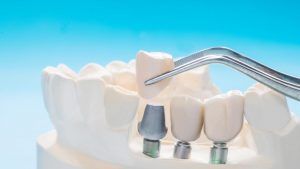 La duración de un implante dental se alarga con un buen mantenimiento