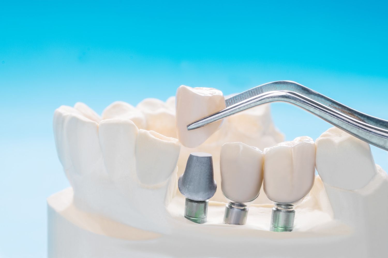 La duración de un implante dental se alarga con un buen mantenimiento