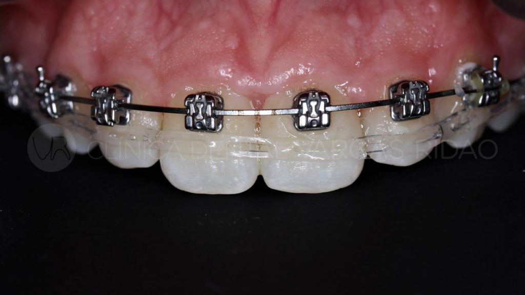 Decantarse por Invisalign o brackets requiere de un buen diagnóstico en la clínica dental