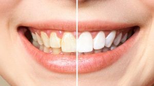 El blanqueamiento dental permite aclarar los dientes de forma rápida e indolora