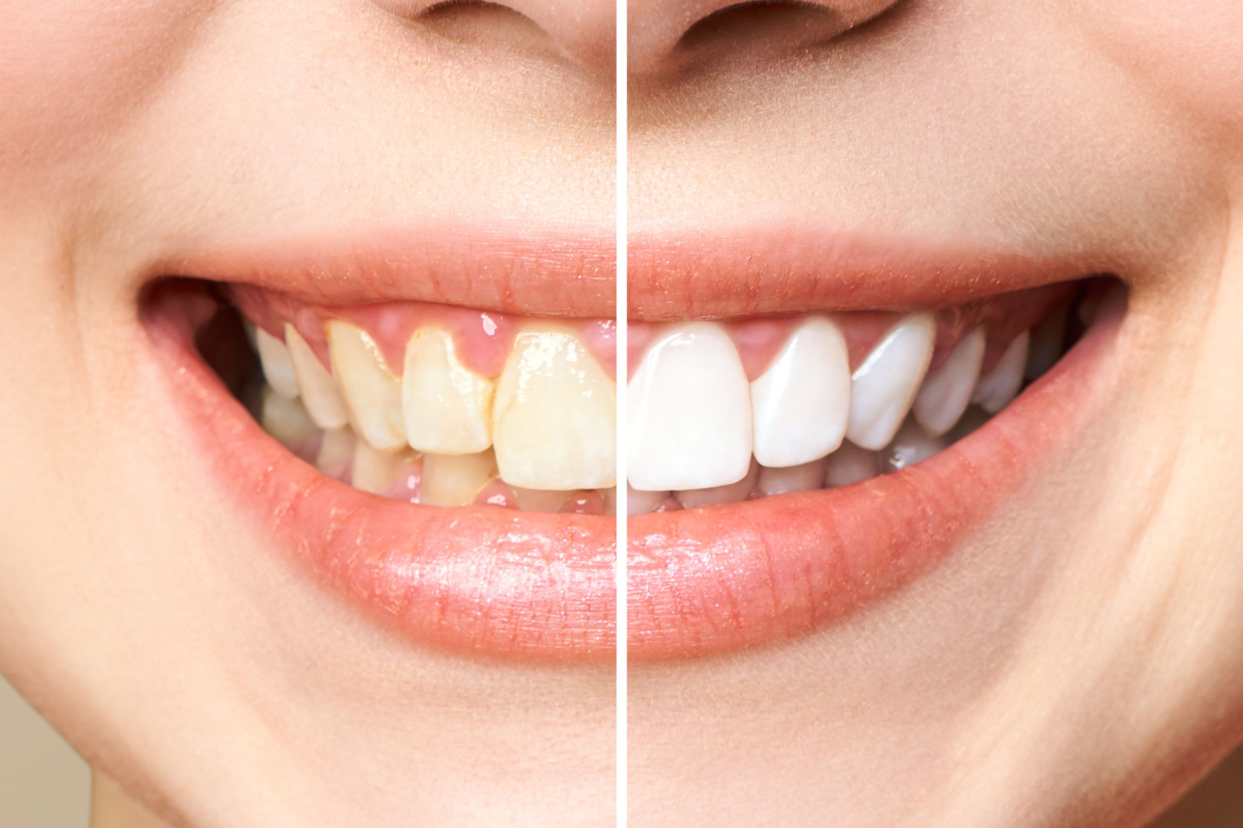 El blanqueamiento dental permite aclarar los dientes de forma rápida e indolora