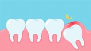 La pericoronaritis debe tratarse en la clínica dental cuanto antes