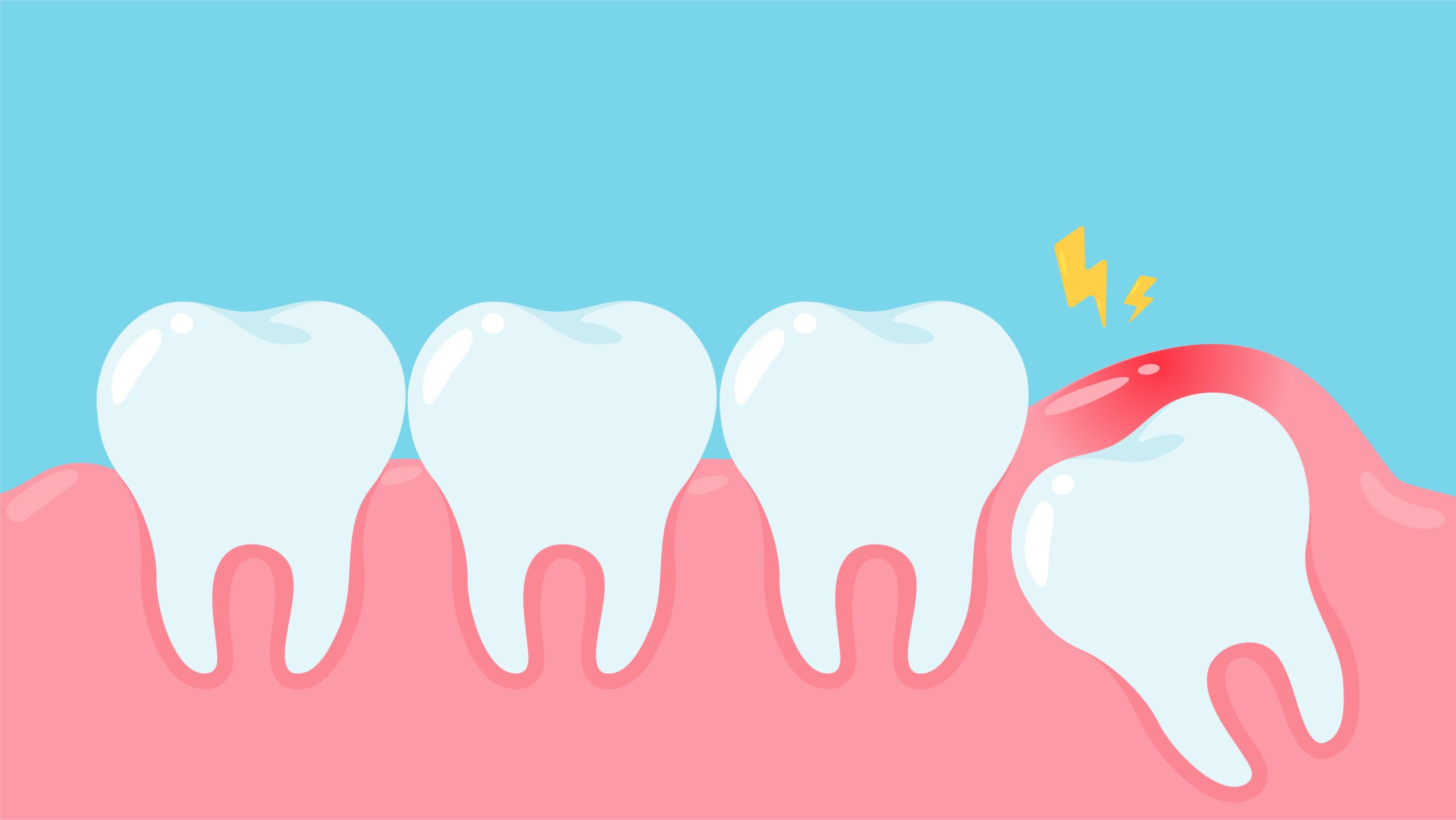 La pericoronaritis debe tratarse en la clínica dental cuanto antes