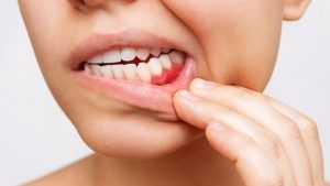 Las encías retraídas se originan por diferentes causas, como mala higiene dental o sufrir de periodontitis