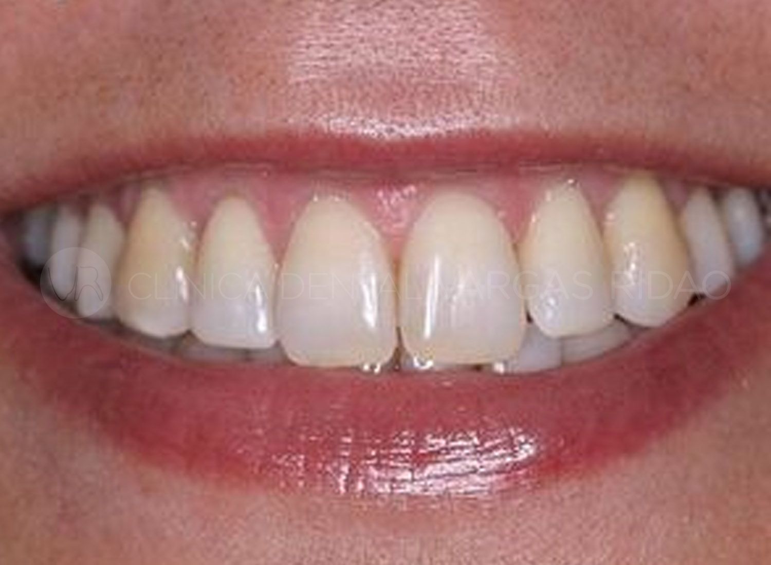 ortodoncia-pitts21-4