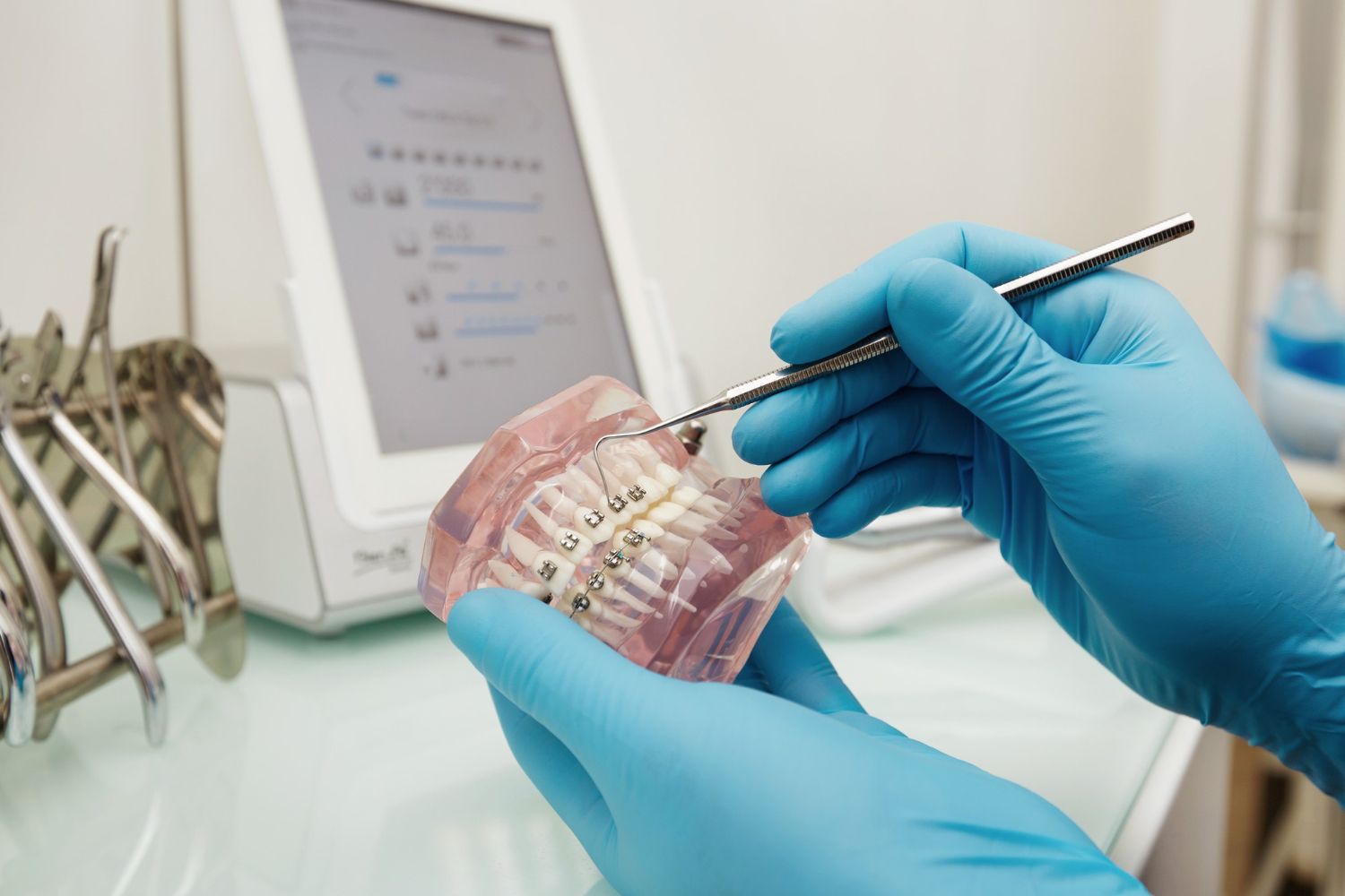 Los microtornillos en ortodoncia ofrecen muy buenos resultados y se pueden combinar con brackets u ortodoncia invisible