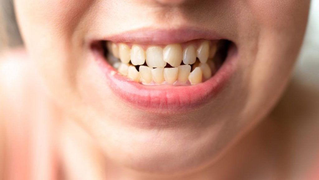 : Para alinear los dientes montados se pueden utilizar diversos tratamientos de ortodoncia, como Invisalign o brackets