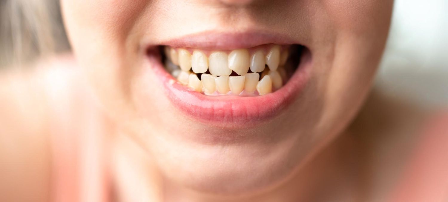 : Para alinear los dientes montados se pueden utilizar diversos tratamientos de ortodoncia, como Invisalign o brackets