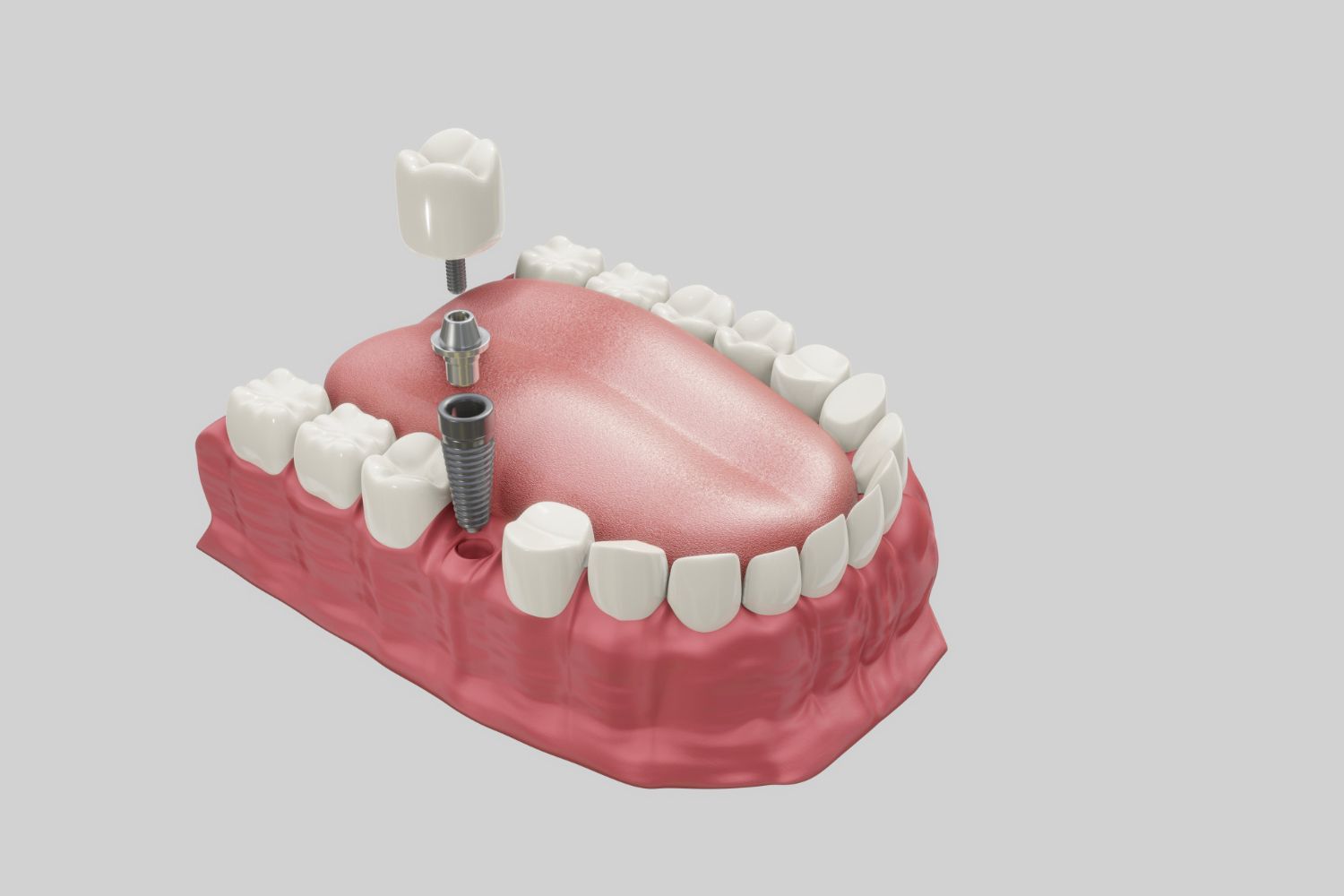 Debe colocarse el implante dental cuanto antes para evitar complicaciones