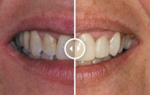 antes y despues carillas dentales