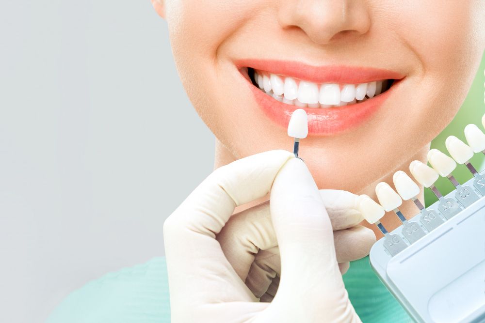 Al ponerse carillas dentales se ocultan pequeñas imperfecciones de los dientes